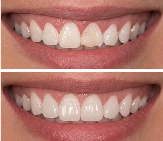 De-identified before-and-after dental photographs showing bonding and veneer treatment