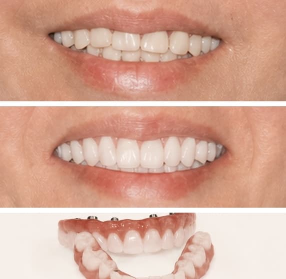 De-identified before-and-after dental photographs showing a fixed implant bridge