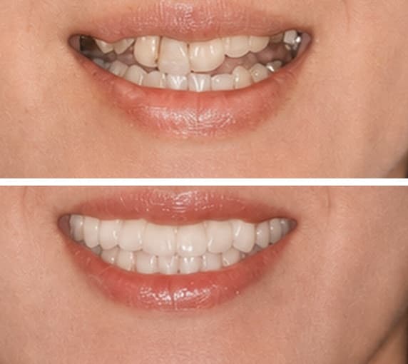 De-identified before-and-after dental photographs showing full-mouth reconstruction