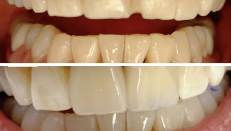 De-identified before-and-after dental photographs showing repair of a chipped tooth