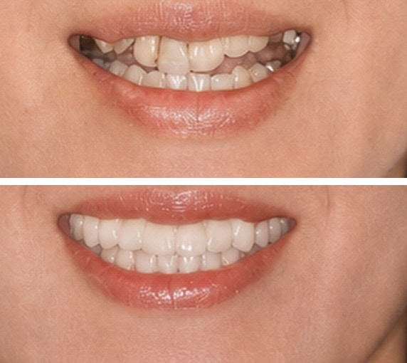 De-identified before-and-after dental photographs showing full-mouth reconstruction