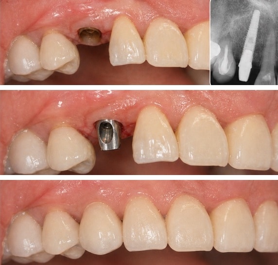 De-identified clinical sequence showing implant restoration after infection