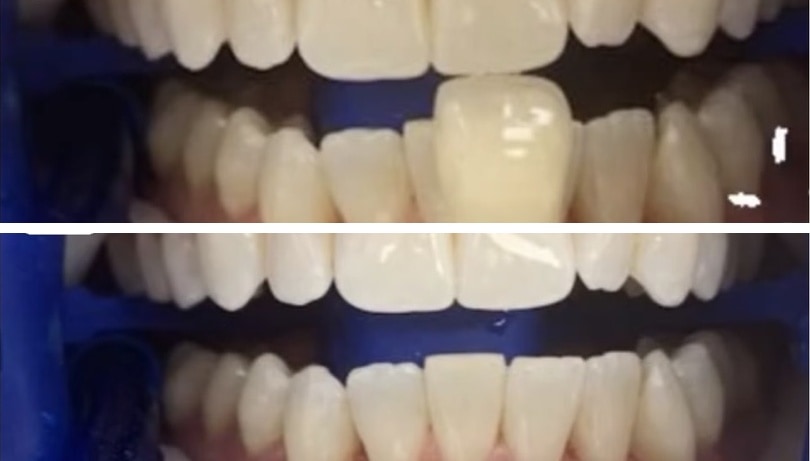 De-identified before-and-after dental photographs showing professional whitening results